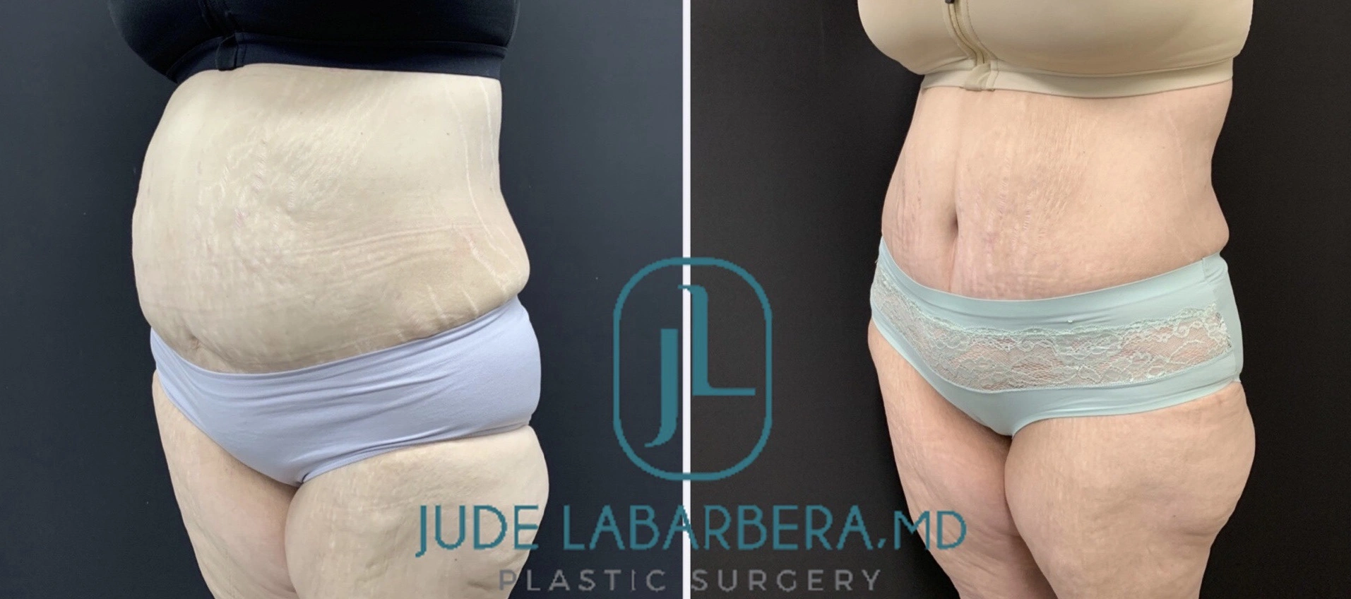 REVISION TUMMY TUCK WITH NEOUMBILICOPLASTY Before & After Case Number 00086