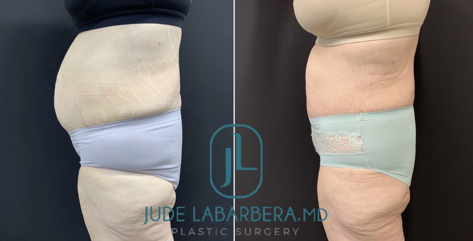 REVISION TUMMY TUCK WITH NEOUMBILICOPLASTY Before & After Case Number 00086