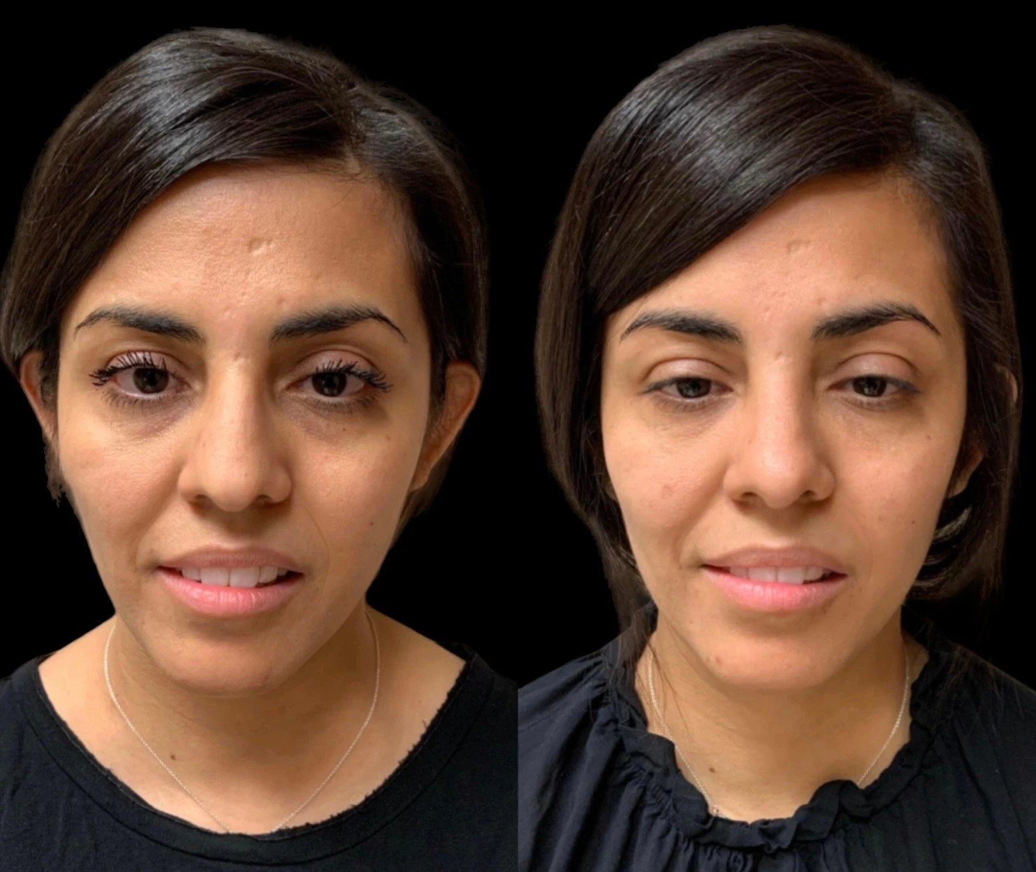 RHINOPLASTY Before & After Case Number 0001