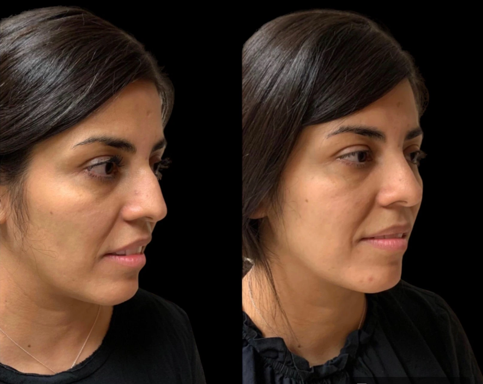 RHINOPLASTY Before & After Case Number 0001