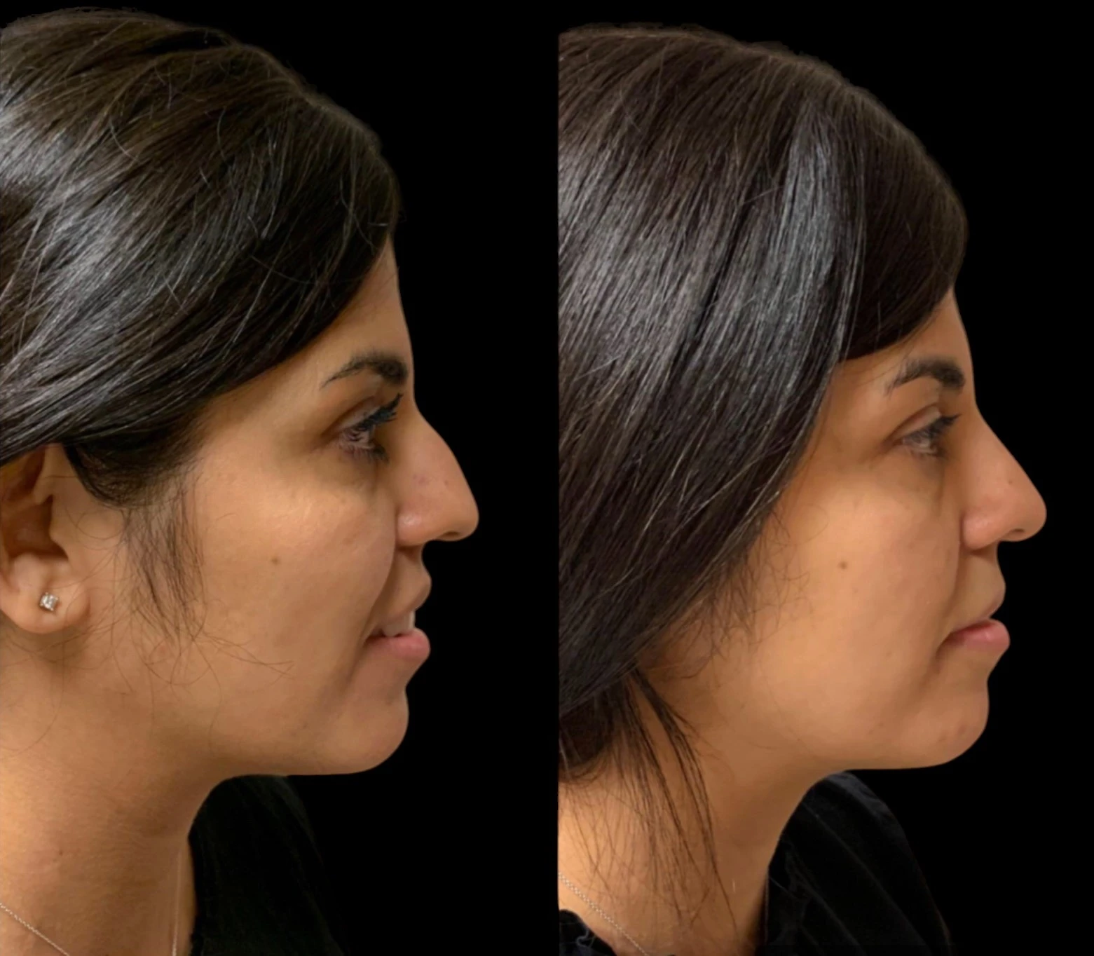 RHINOPLASTY Before & After Case Number 0001