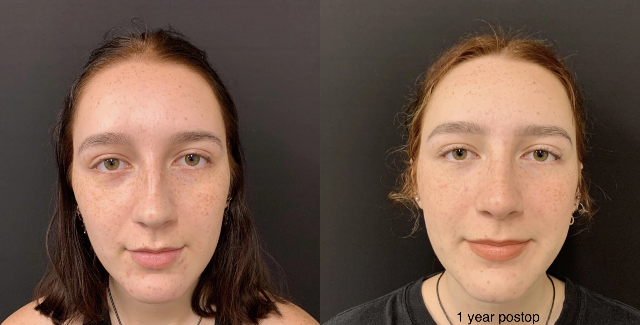 RHINOPLASTY Before & After Case Number 0002