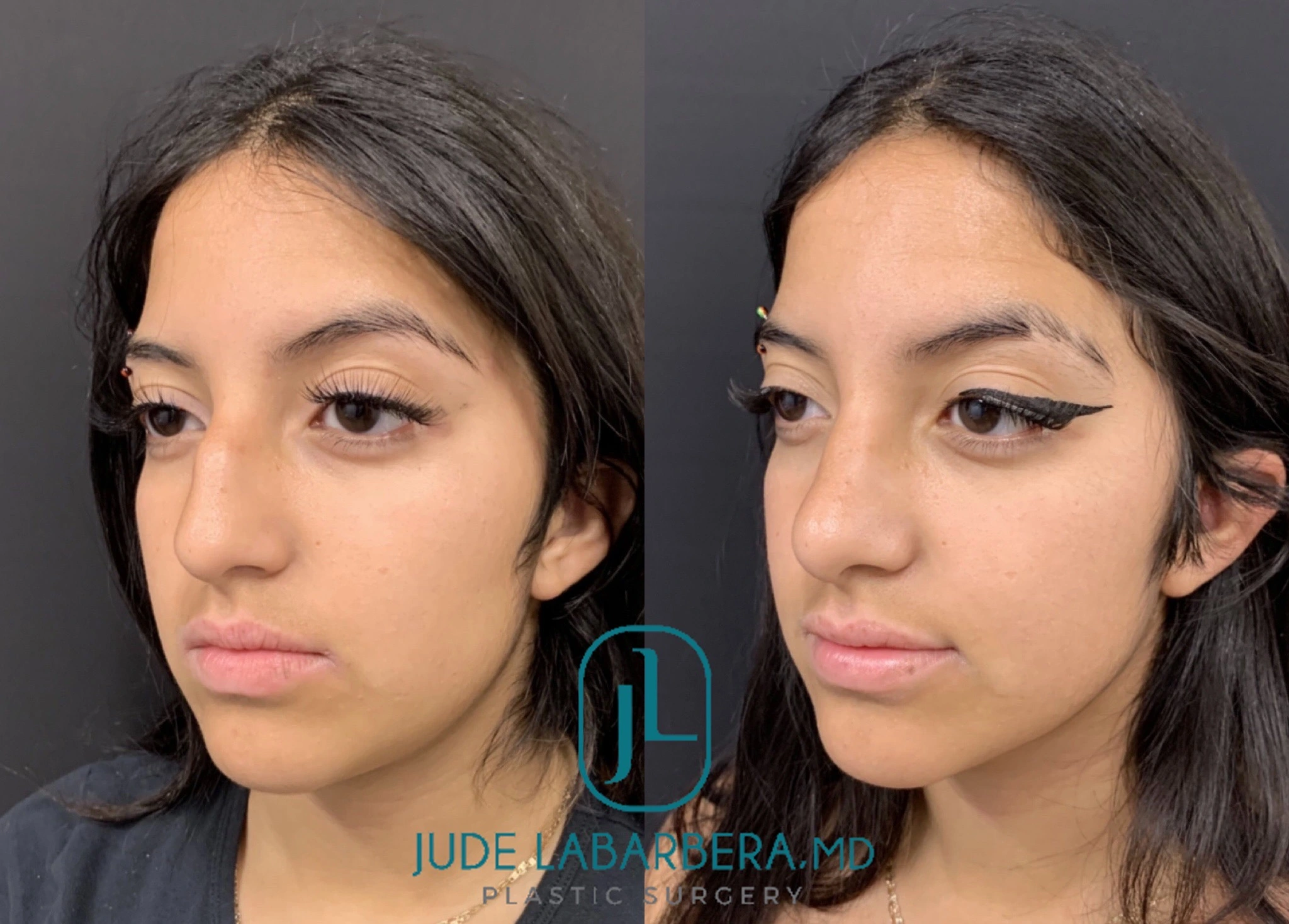 RHINOPLASTY Before & After Case Number 0003