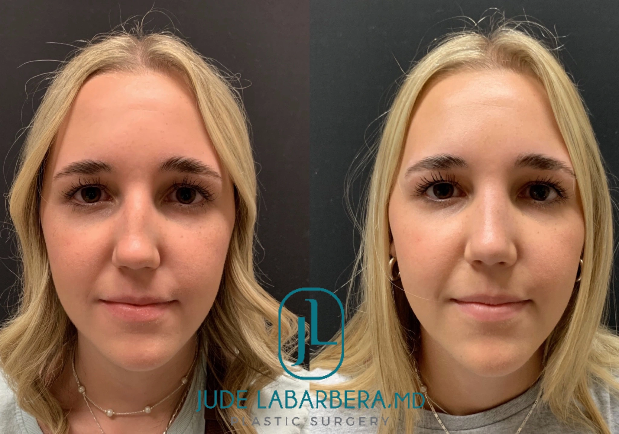 RHINOPLASTY Before & After Case Number 0004