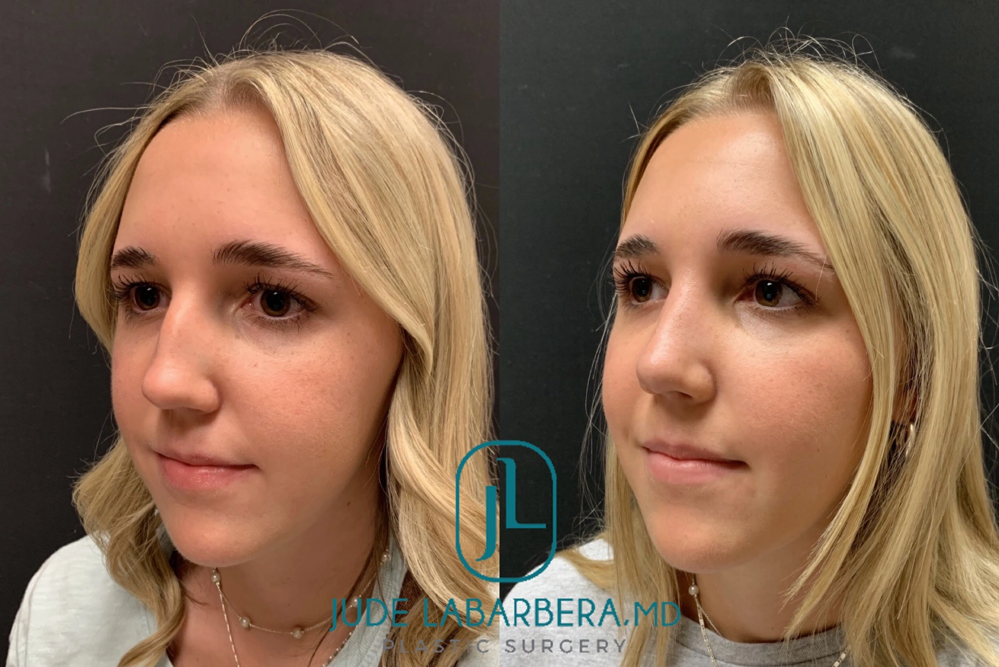RHINOPLASTY Before & After Case Number 0004