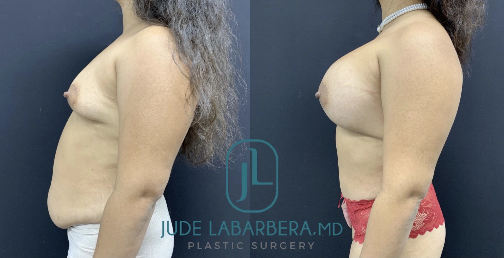 STUNNING MOMMY MAKEOVER Before & After Case Number 00065