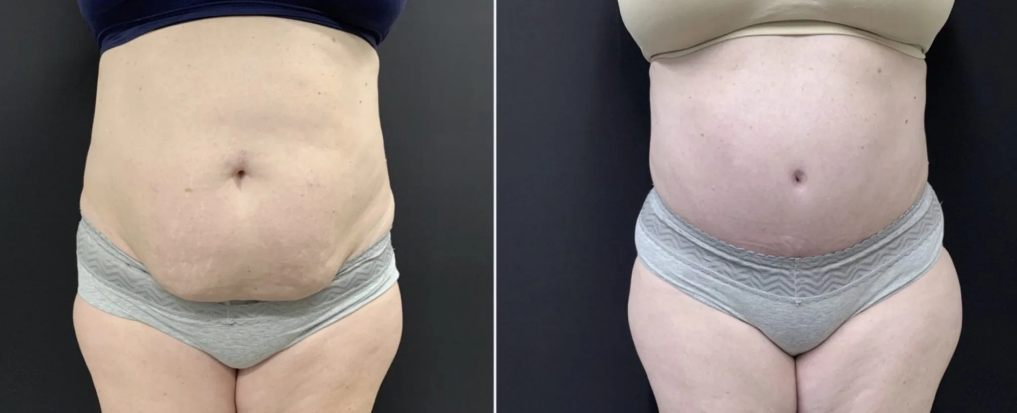 TUMMY TUCK AND LIPOSUCTION OF THE FLANKS Before & After Case Number 00014