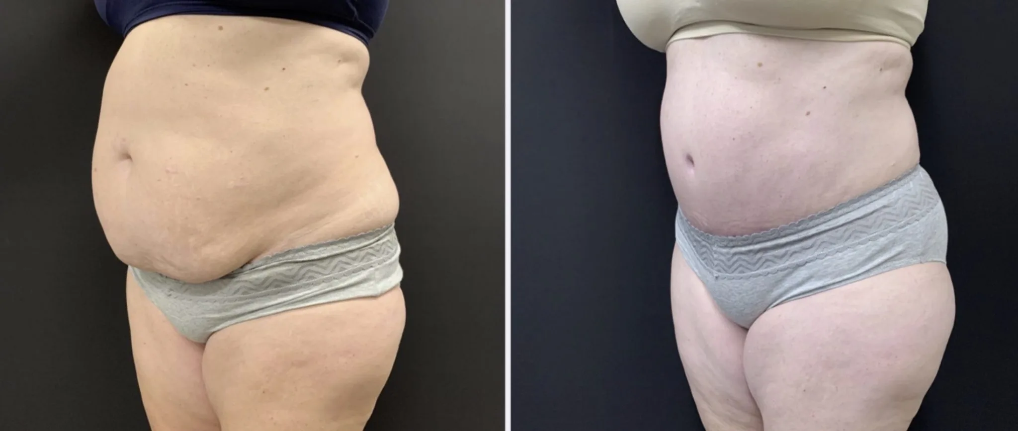 TUMMY TUCK AND LIPOSUCTION OF THE FLANKS Before & After Case Number 00014