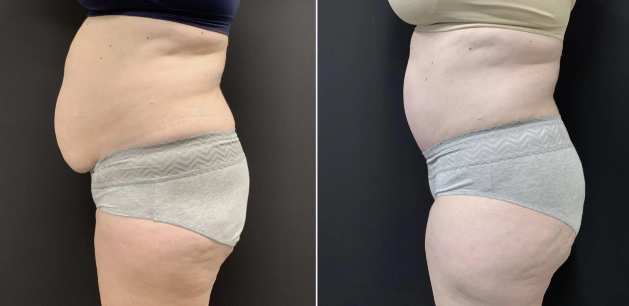 TUMMY TUCK AND LIPOSUCTION OF THE FLANKS Before & After Case Number 00014
