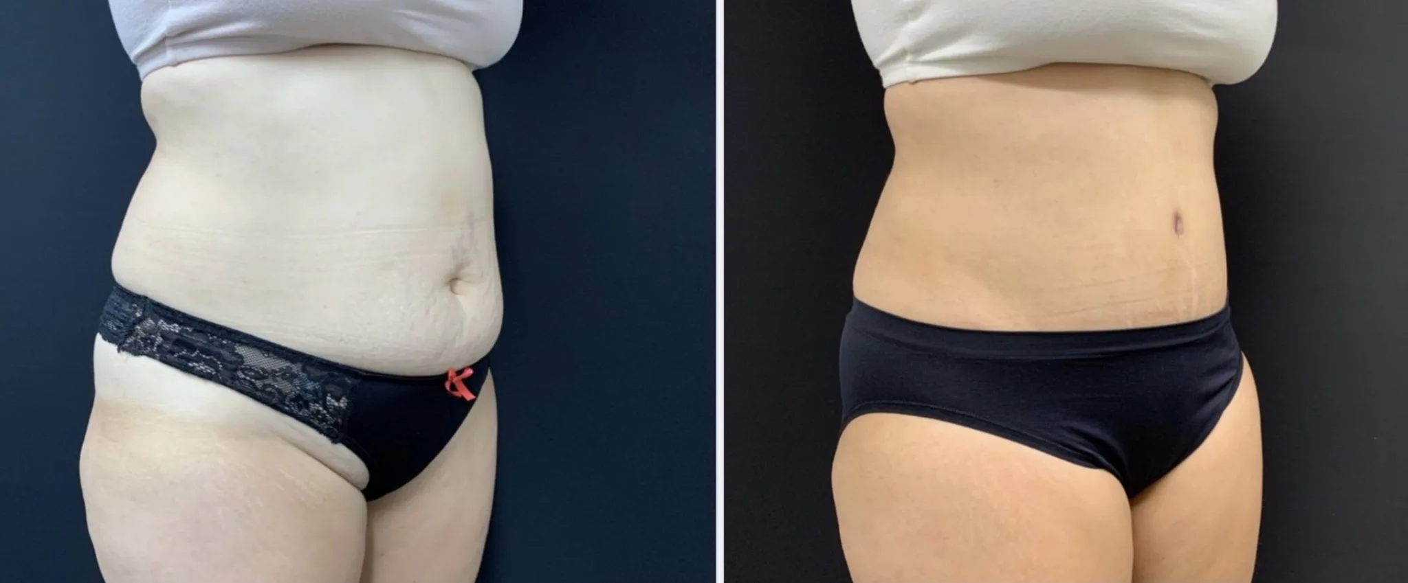 Tummy Tuck Before & After Case Number 00010