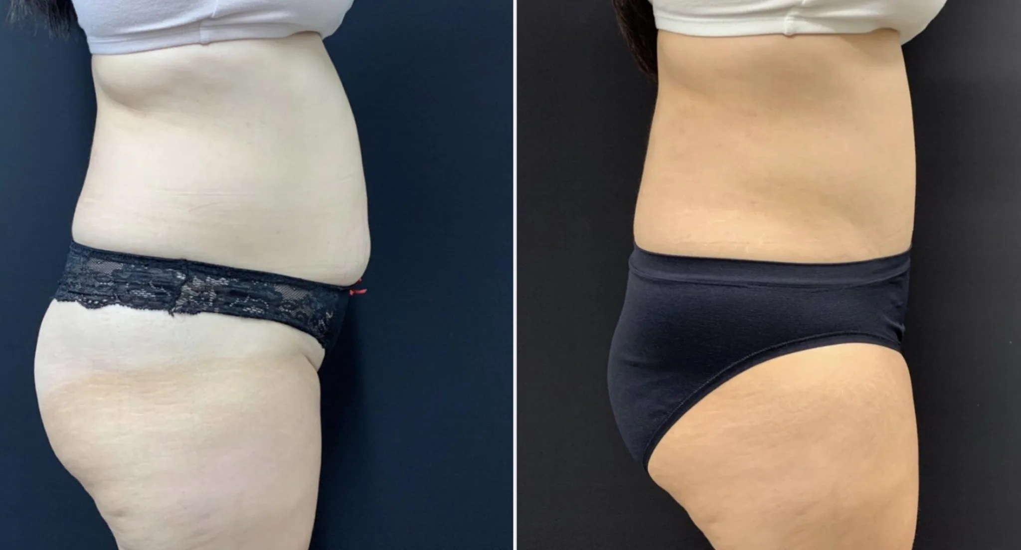 Tummy Tuck Before & After Case Number 00010