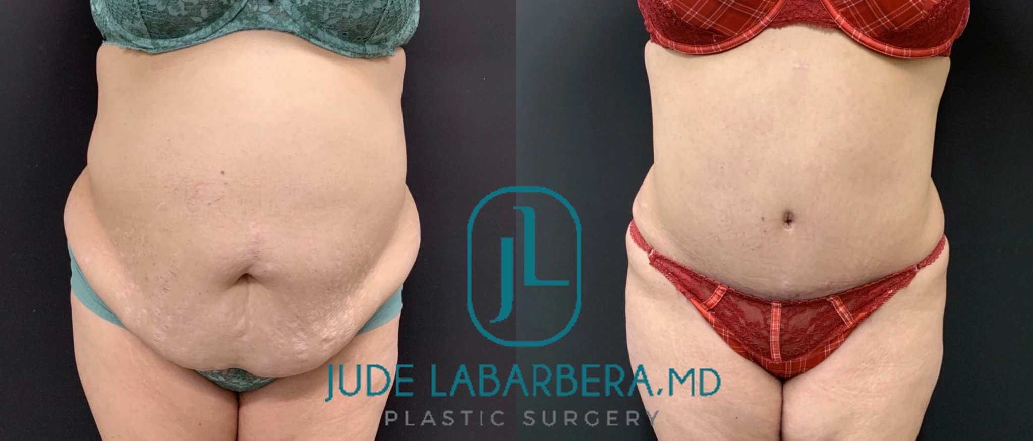 TUMMY TUCK Before & After Case Number 000104