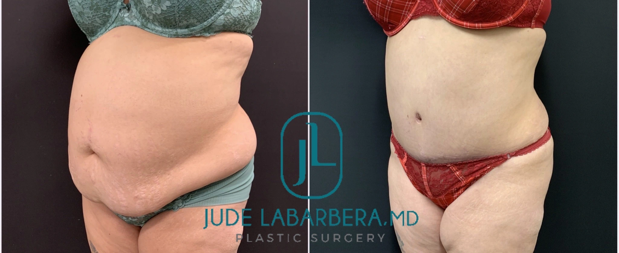 TUMMY TUCK Before & After Case Number 000104