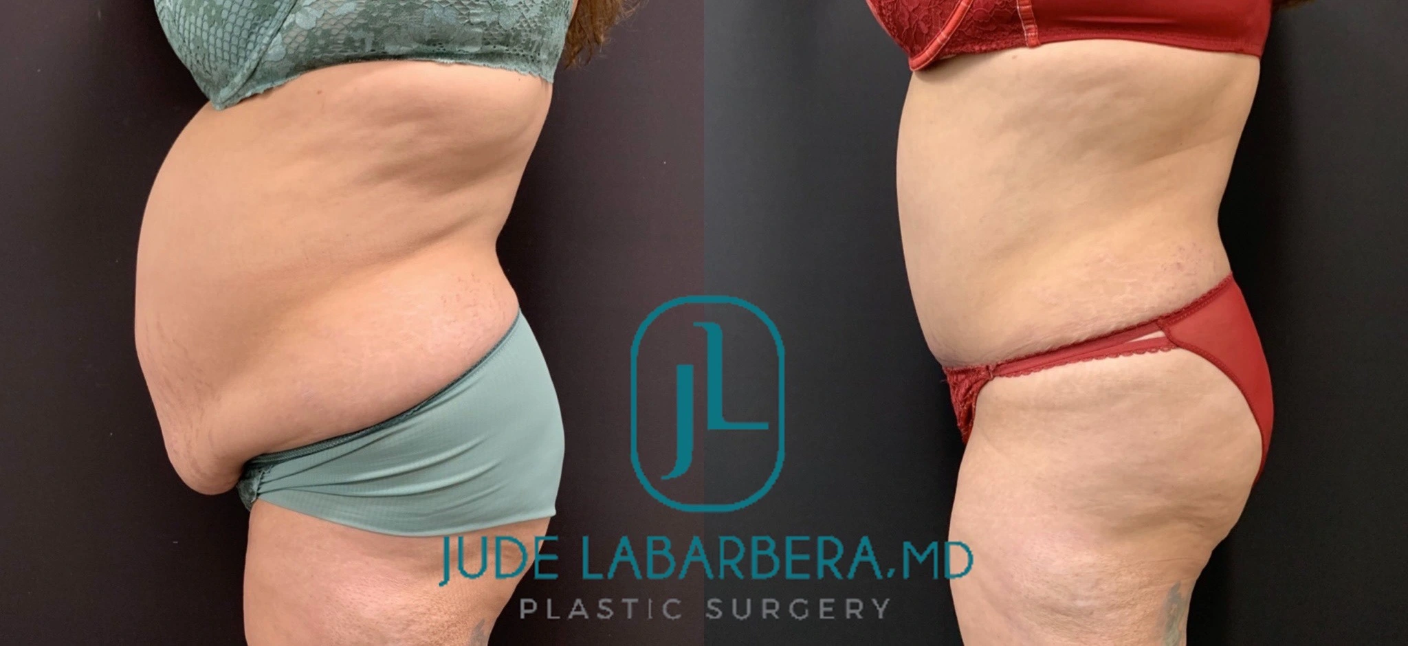 TUMMY TUCK Before & After Case Number 000104