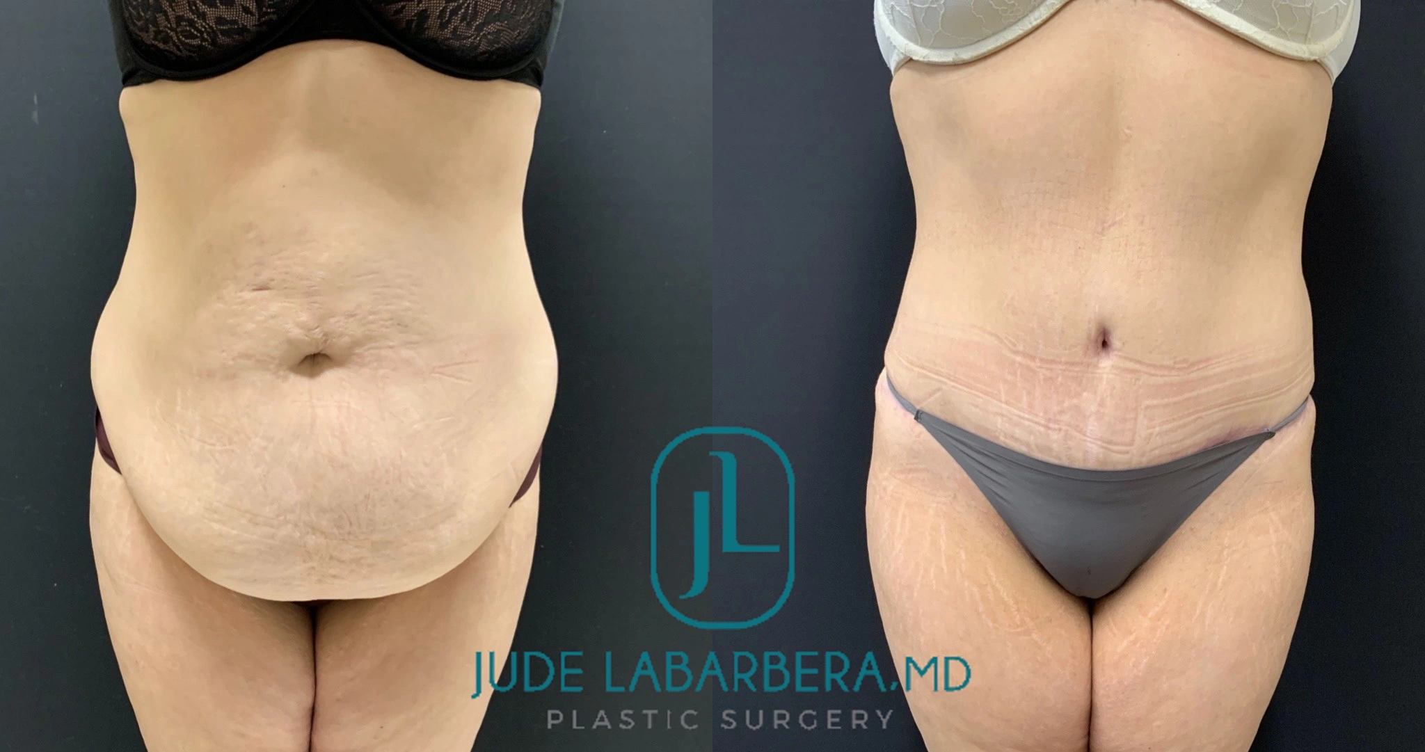 TUMMY TUCK Before & After Case Number 000104