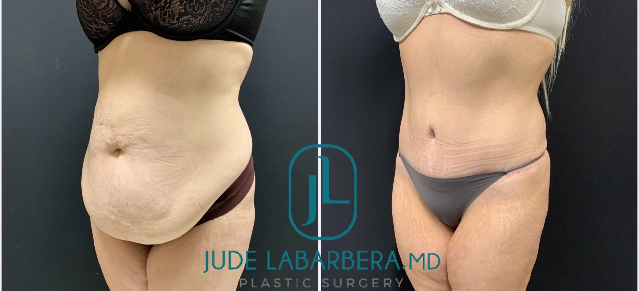 TUMMY TUCK Before & After Case Number 000104
