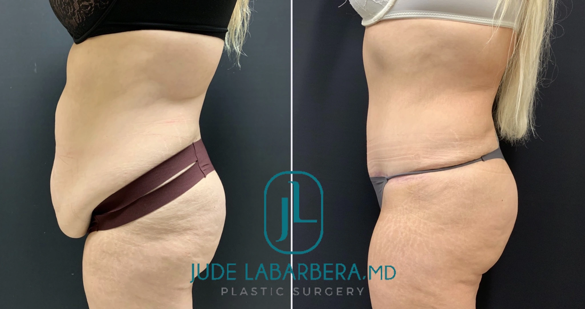 TUMMY TUCK Before & After Case Number 000104