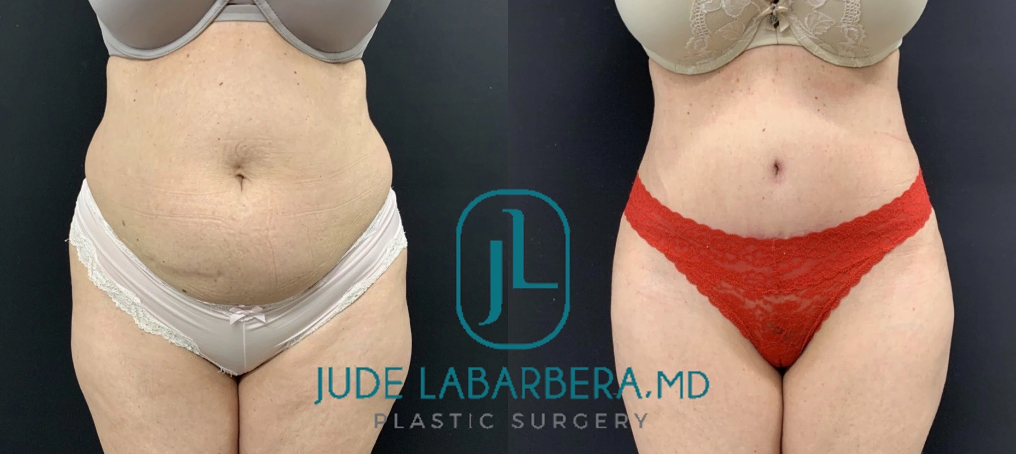 TUMMY TUCK Before & After Case Number 000108
