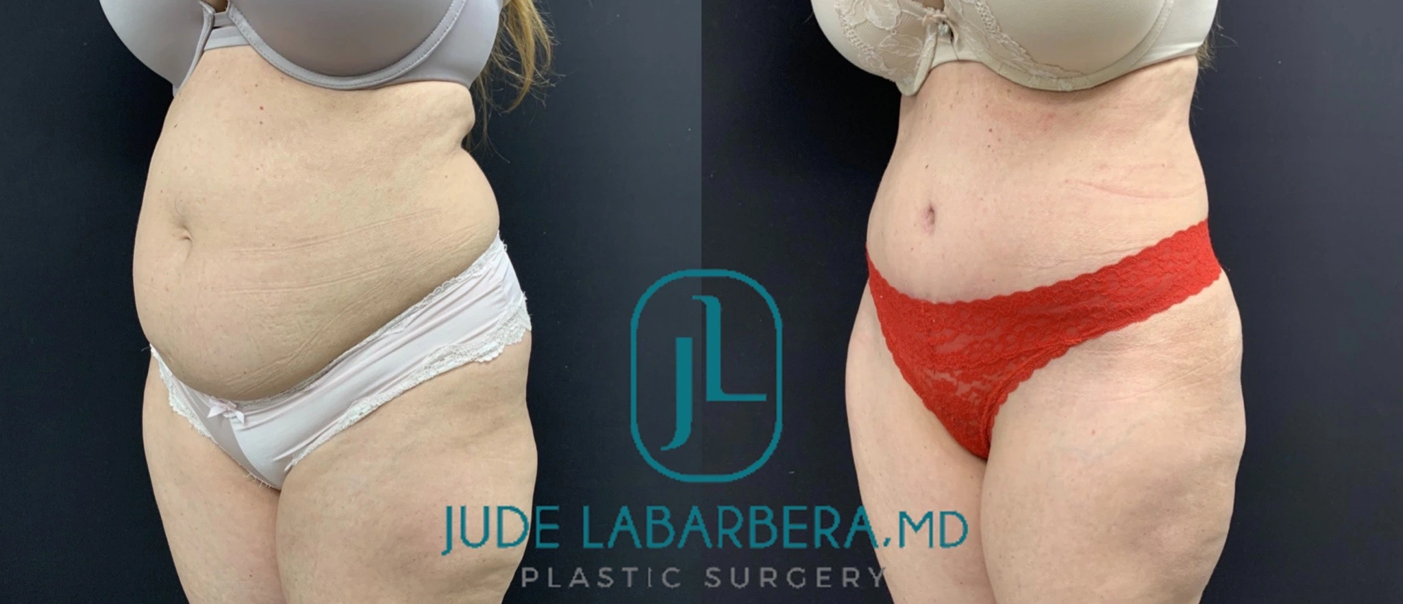 TUMMY TUCK Before & After Case Number 000108