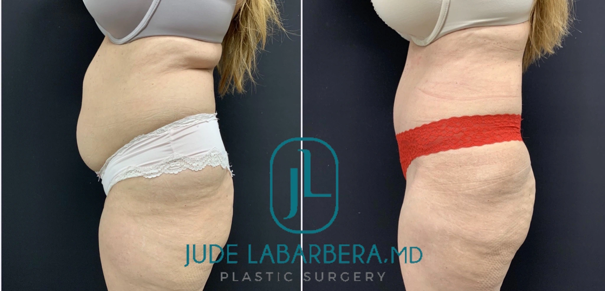 TUMMY TUCK Before & After Case Number 000108