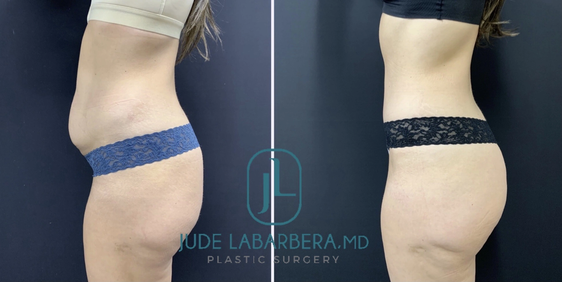TUMMY TUCK Before & After Case Number 000109
