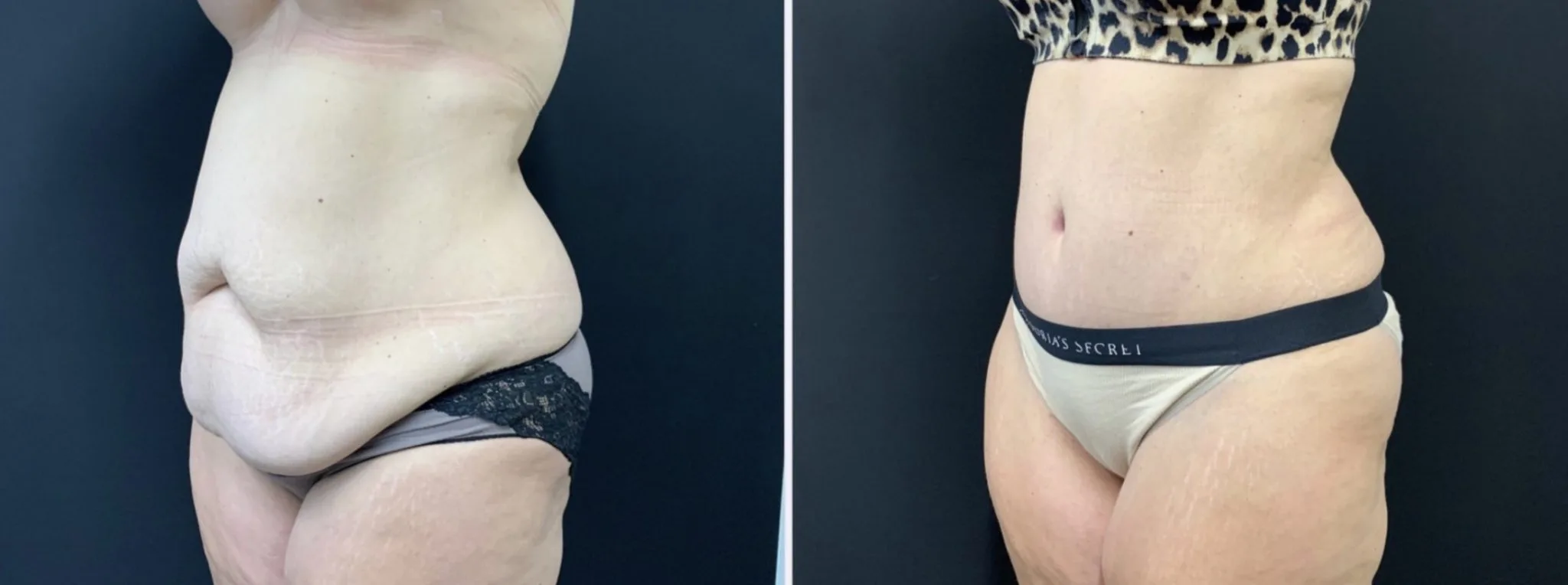 Tummy Tuck Before & After Case Number 00011