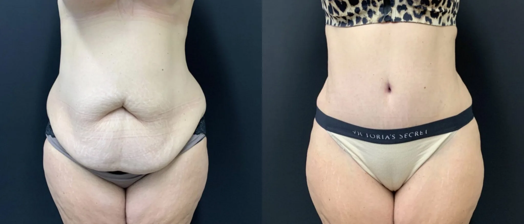 Tummy Tuck Before & After Case Number 00011