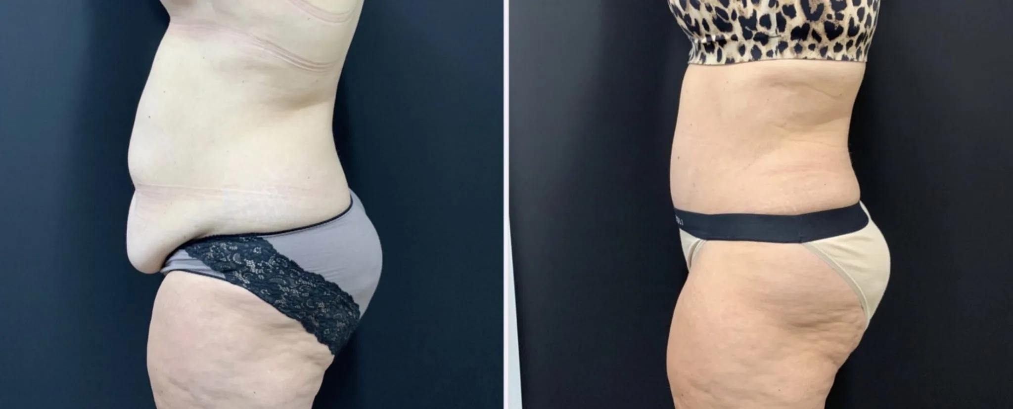 Tummy Tuck Before & After Case Number 00011