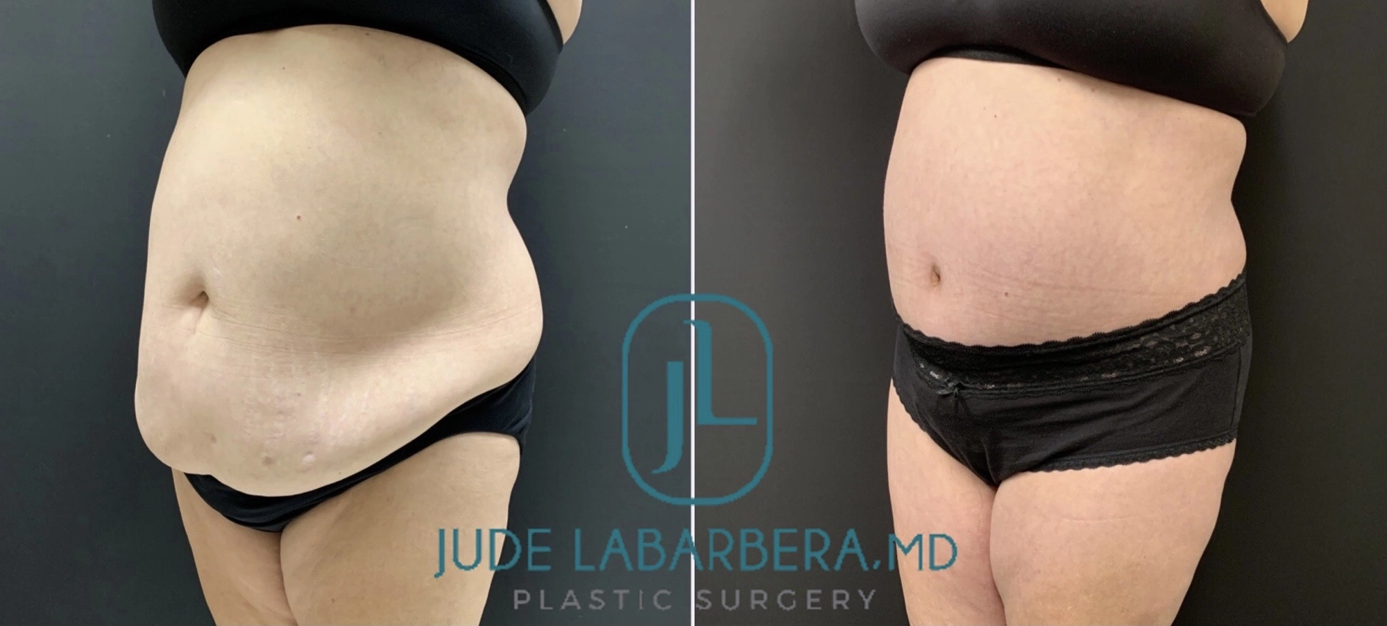 Tummy Tuck Before & After Case Number 00012