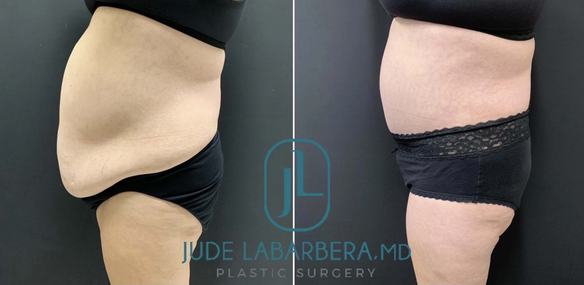 Tummy Tuck Before & After Case Number 00012