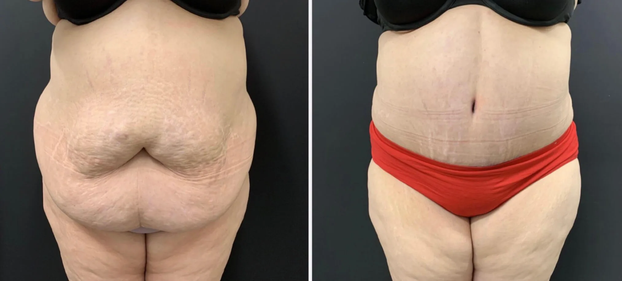 Tummy Tuck Before & After Case Number 00015