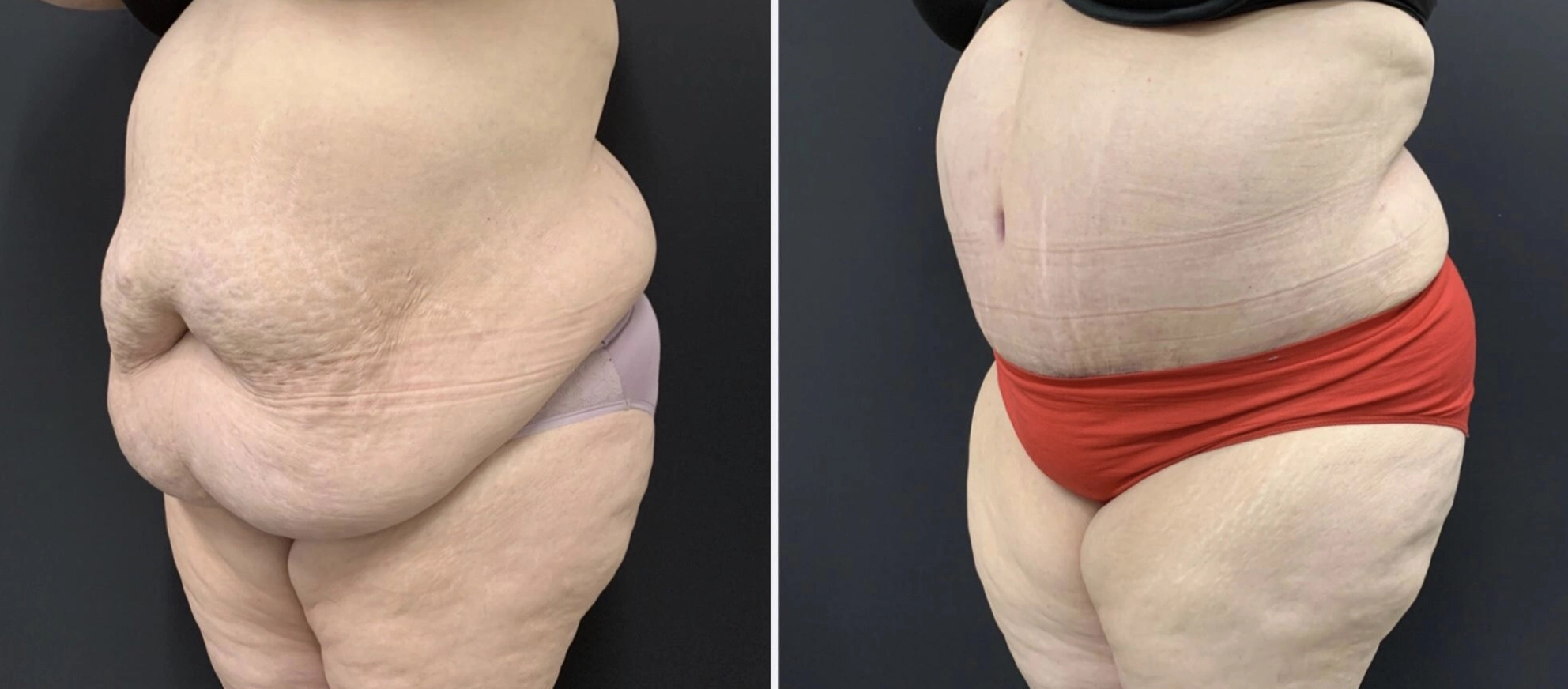 Tummy Tuck Before & After Case Number 00015