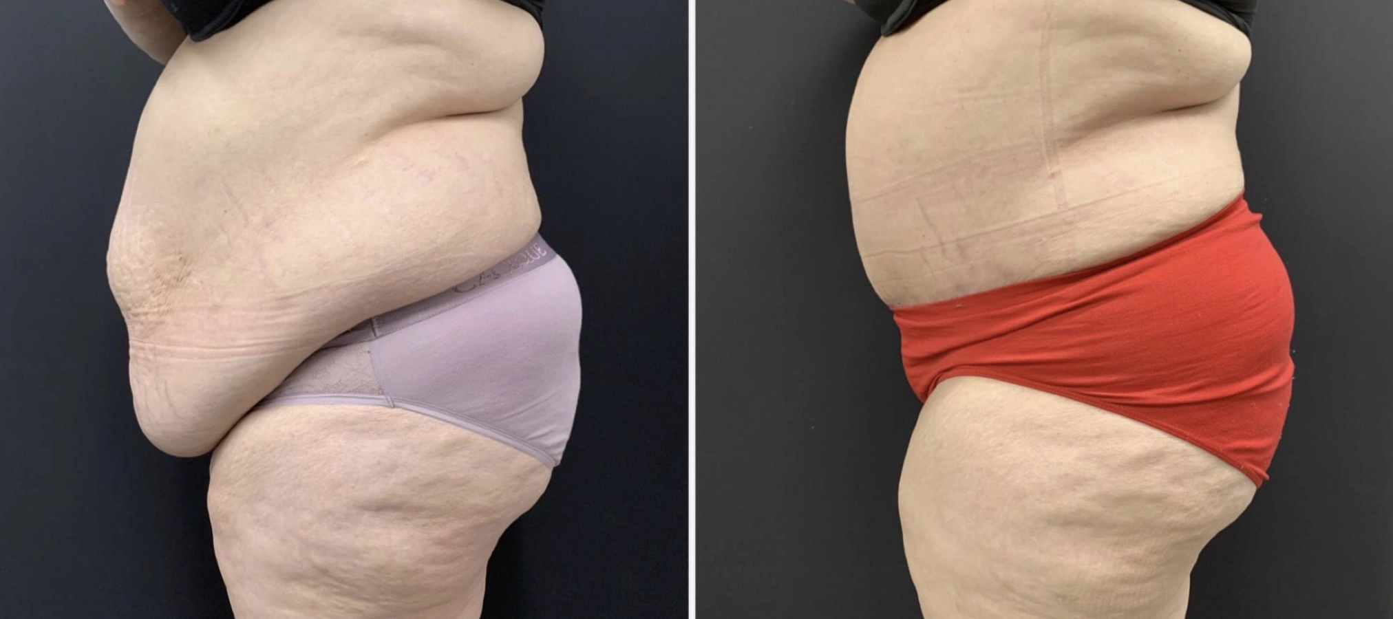 Tummy Tuck Before & After Case Number 00015