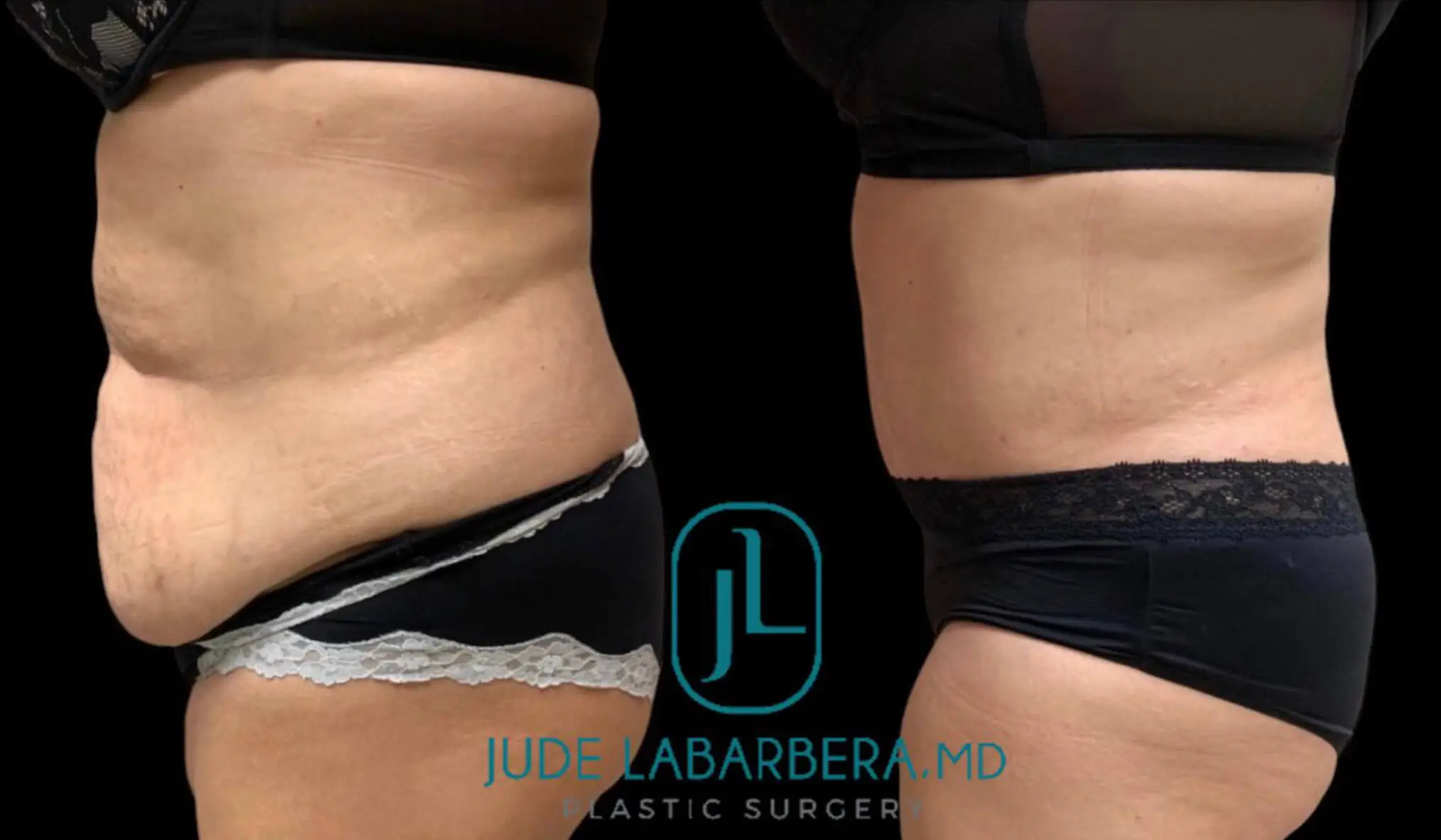 Tummy Tuck Before & After Case Number 00017