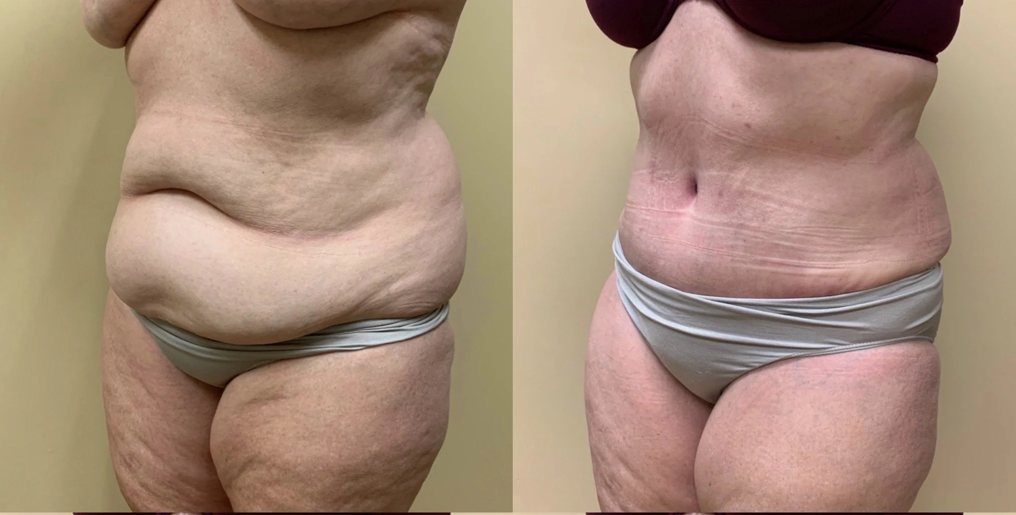 Tummy Tuck Before & After Case Number 00023