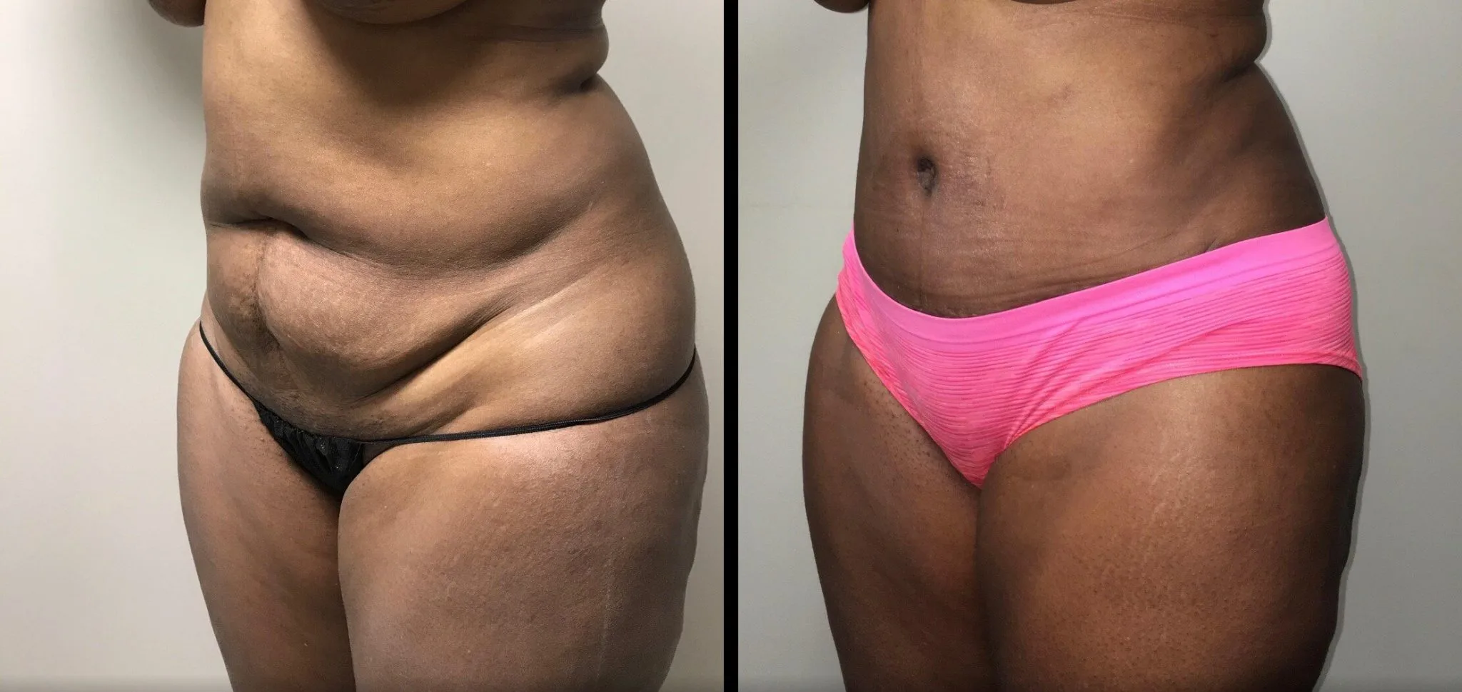 Tummy Tuck Before & After Case Number 00024