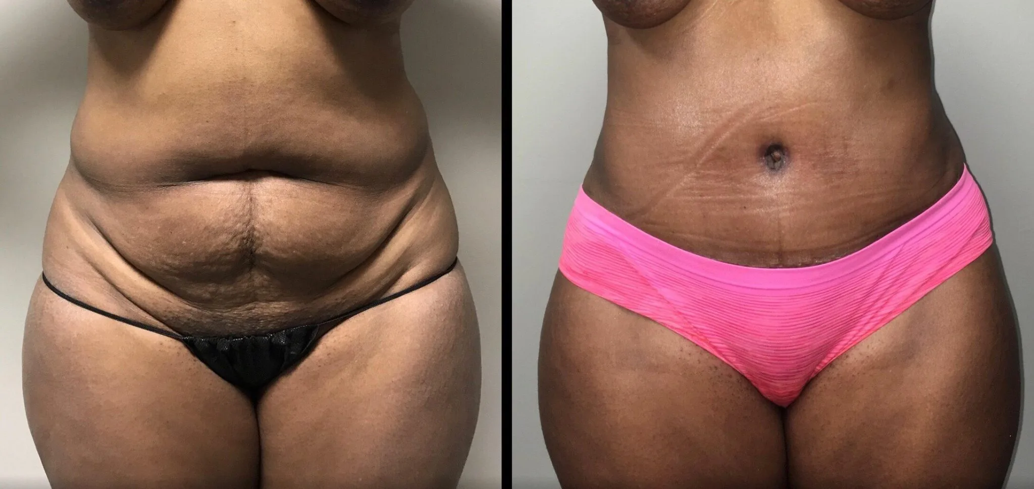 Tummy Tuck Before & After Case Number 00024