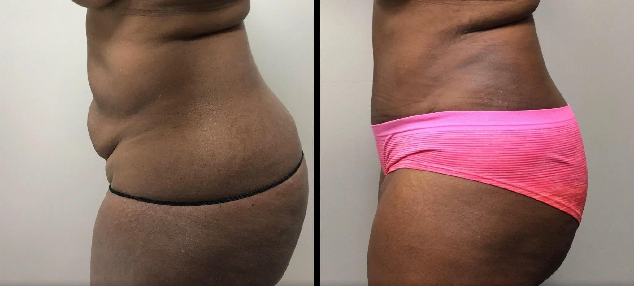 Tummy Tuck Before & After Case Number 00024