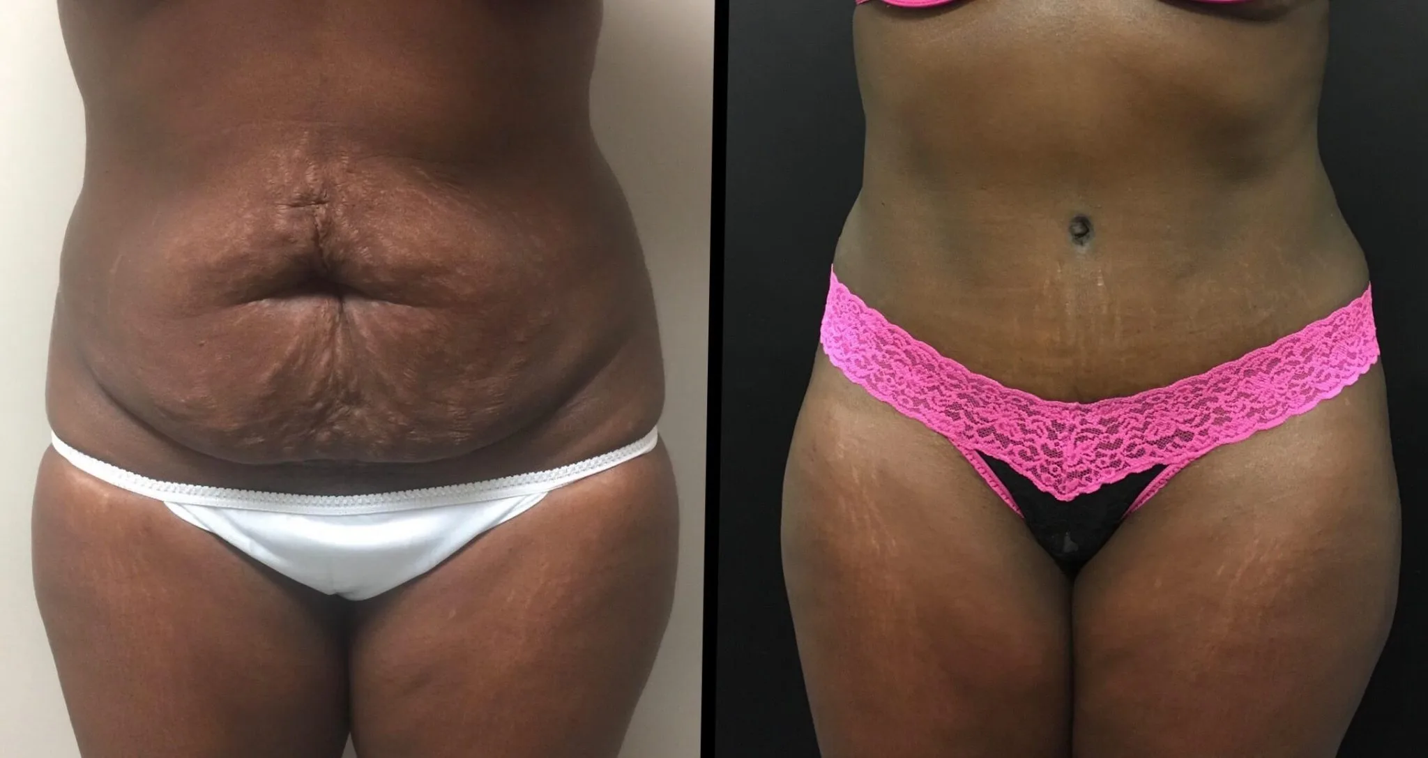 Tummy Tuck Before & After Case Number 00026