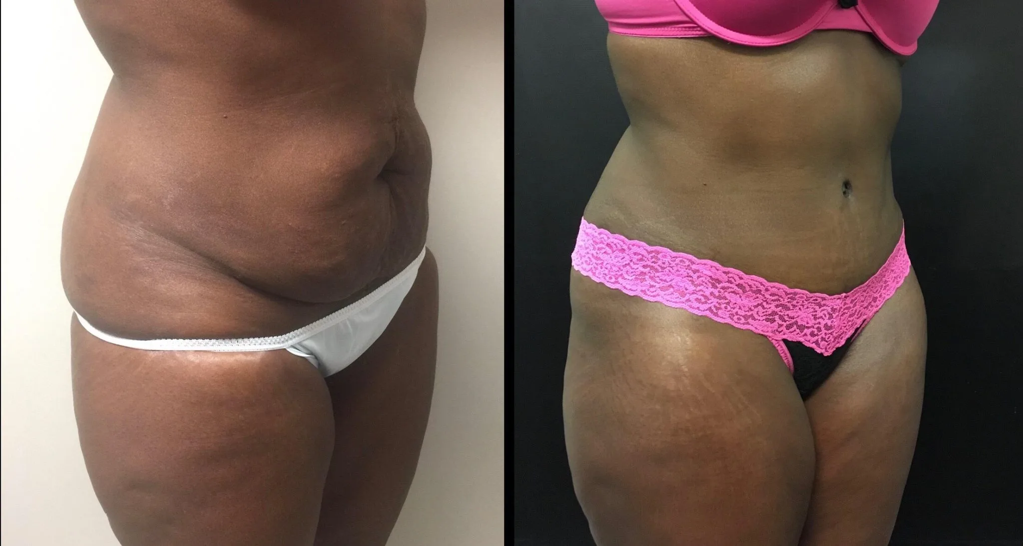 Tummy Tuck Before & After Case Number 00026