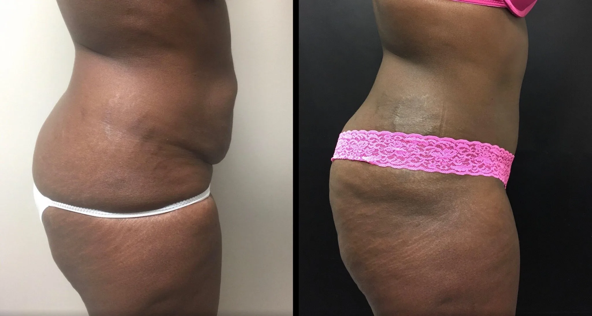 Tummy Tuck Before & After Case Number 00026