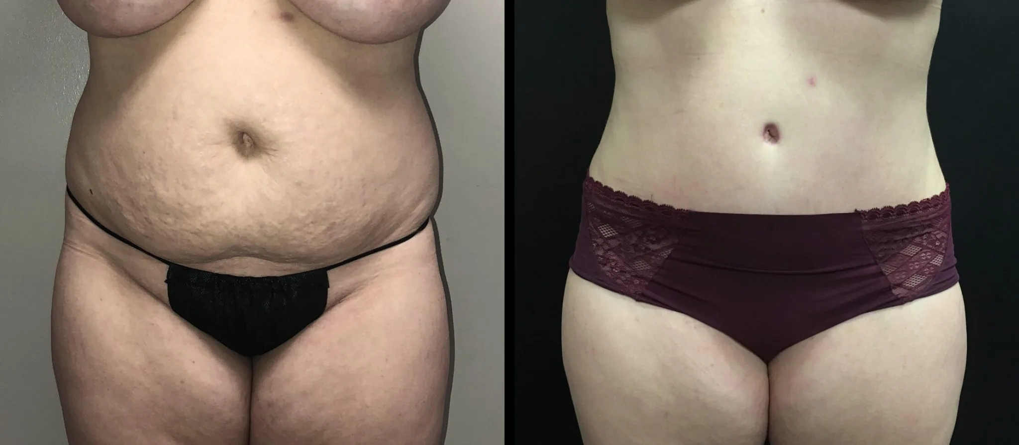 Tummy Tuck Before & After Case Number 00028