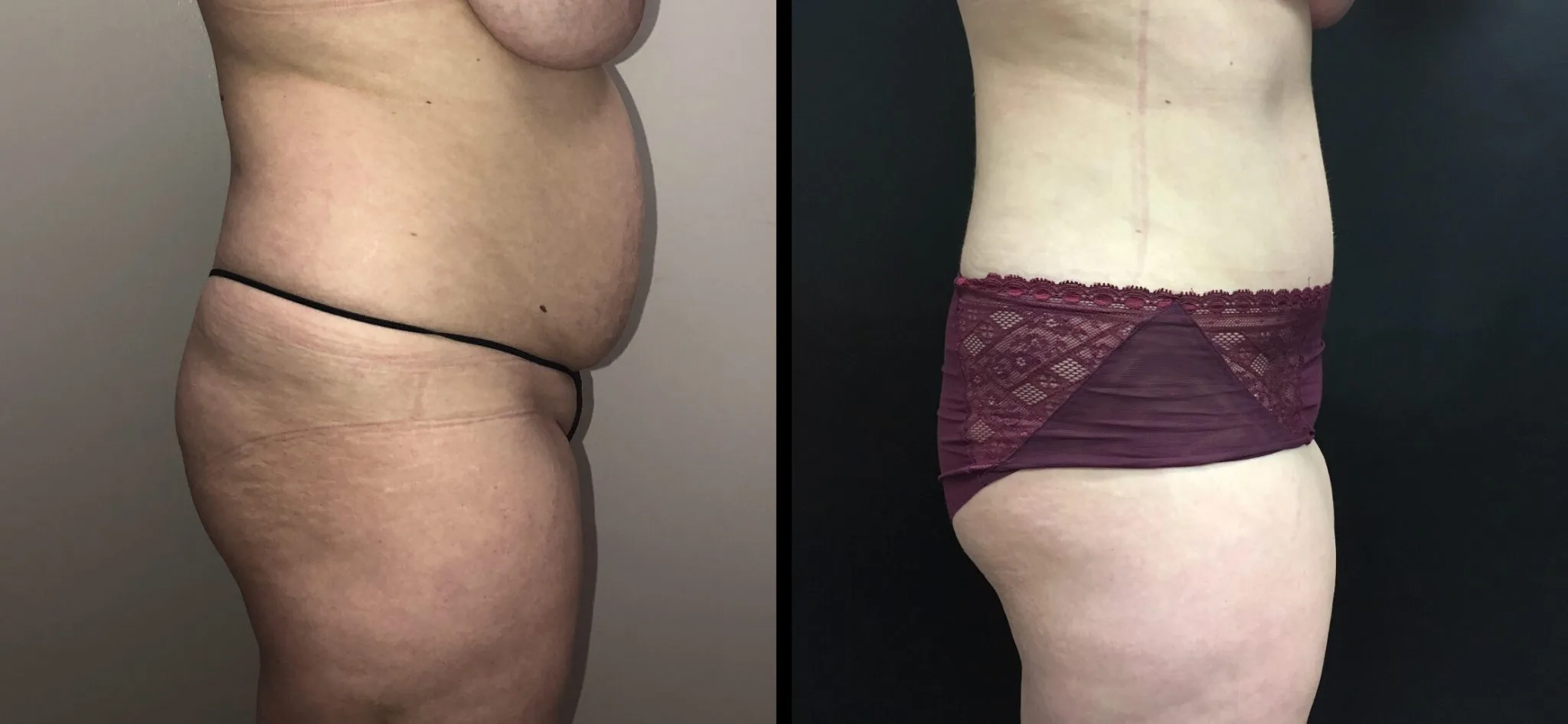 Tummy Tuck Before & After Case Number 00028