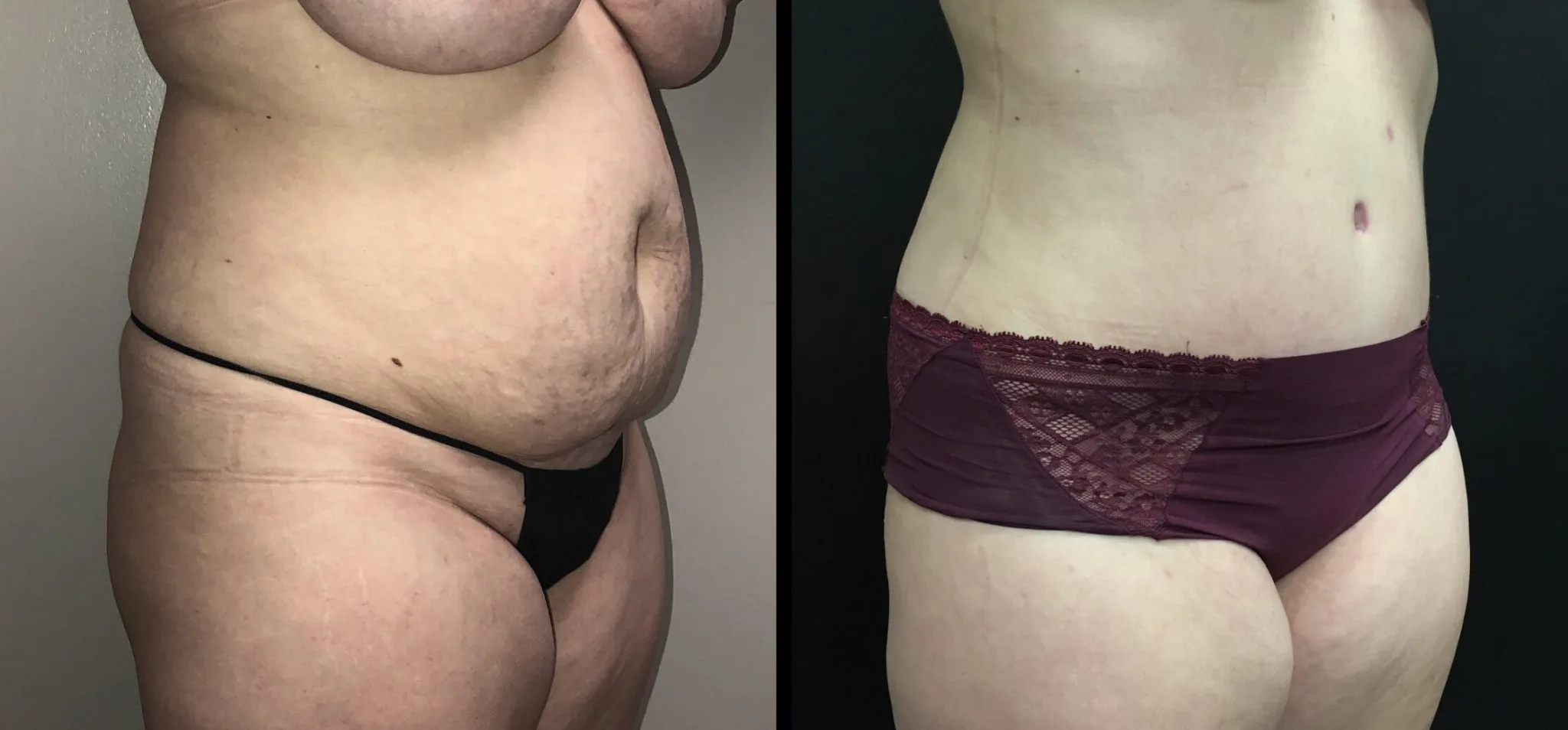 Tummy Tuck Before & After Case Number 00028