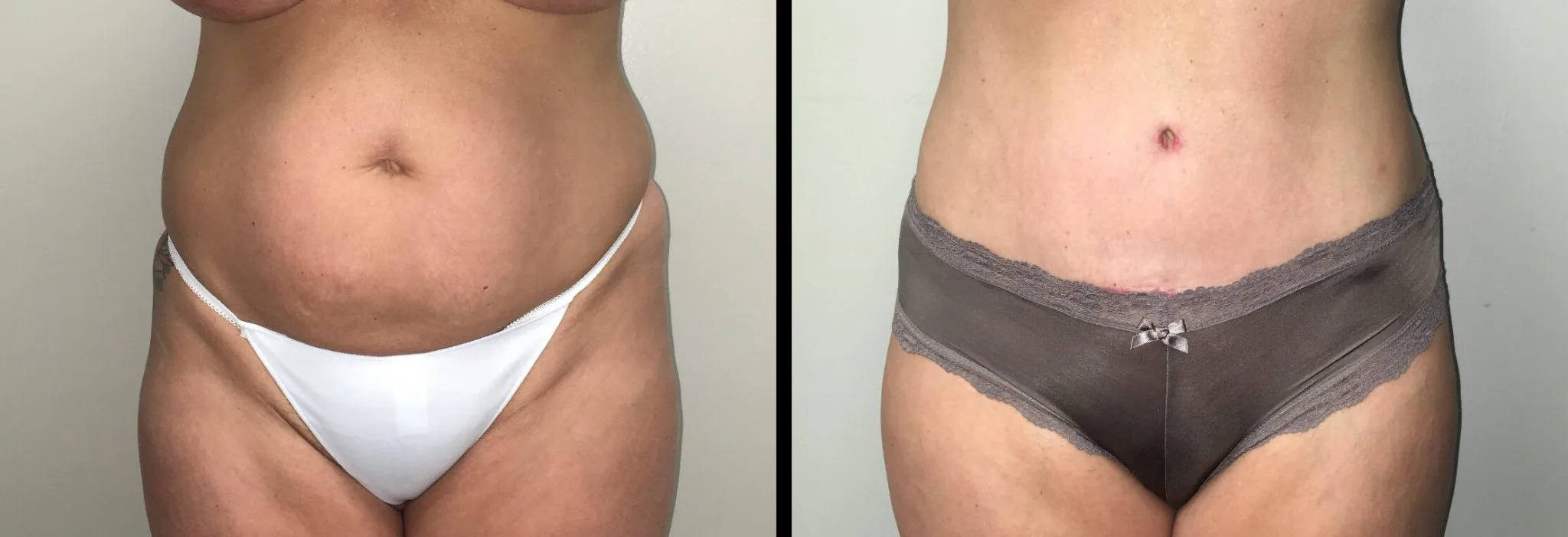 Tummy Tuck Before & After Case Number 00029