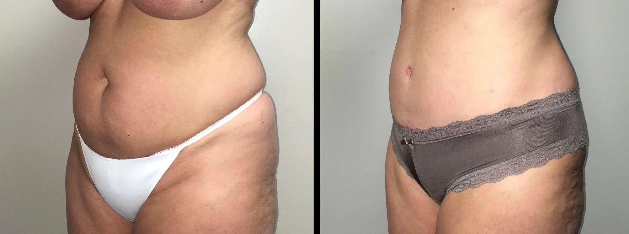 Tummy Tuck Before & After Case Number 00029