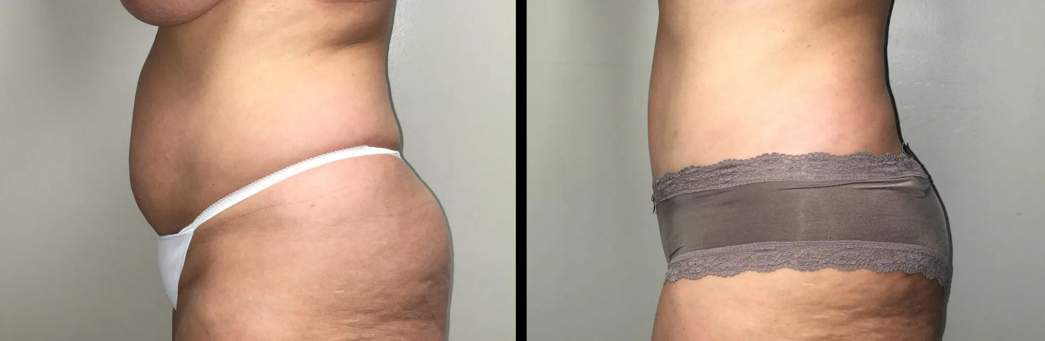 Tummy Tuck Before & After Case Number 00029