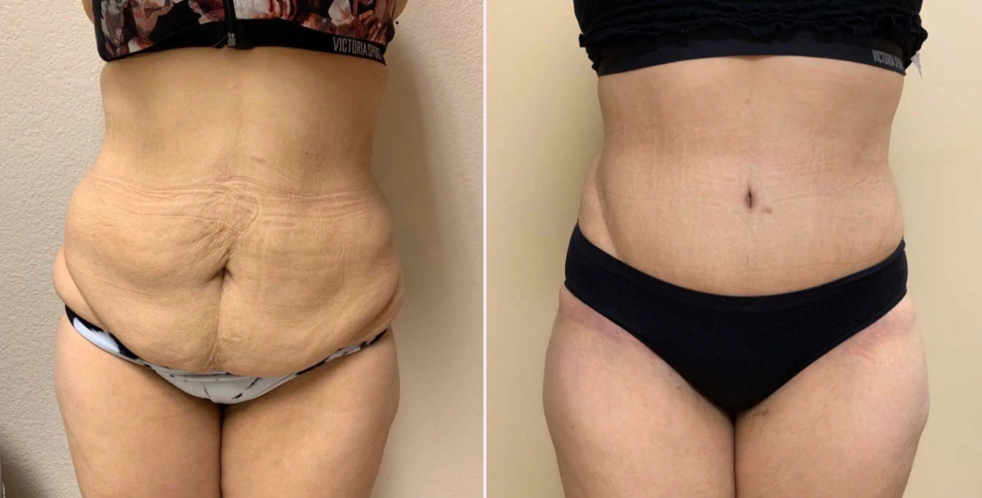 Tummy Tuck Before & After Case Number 00031