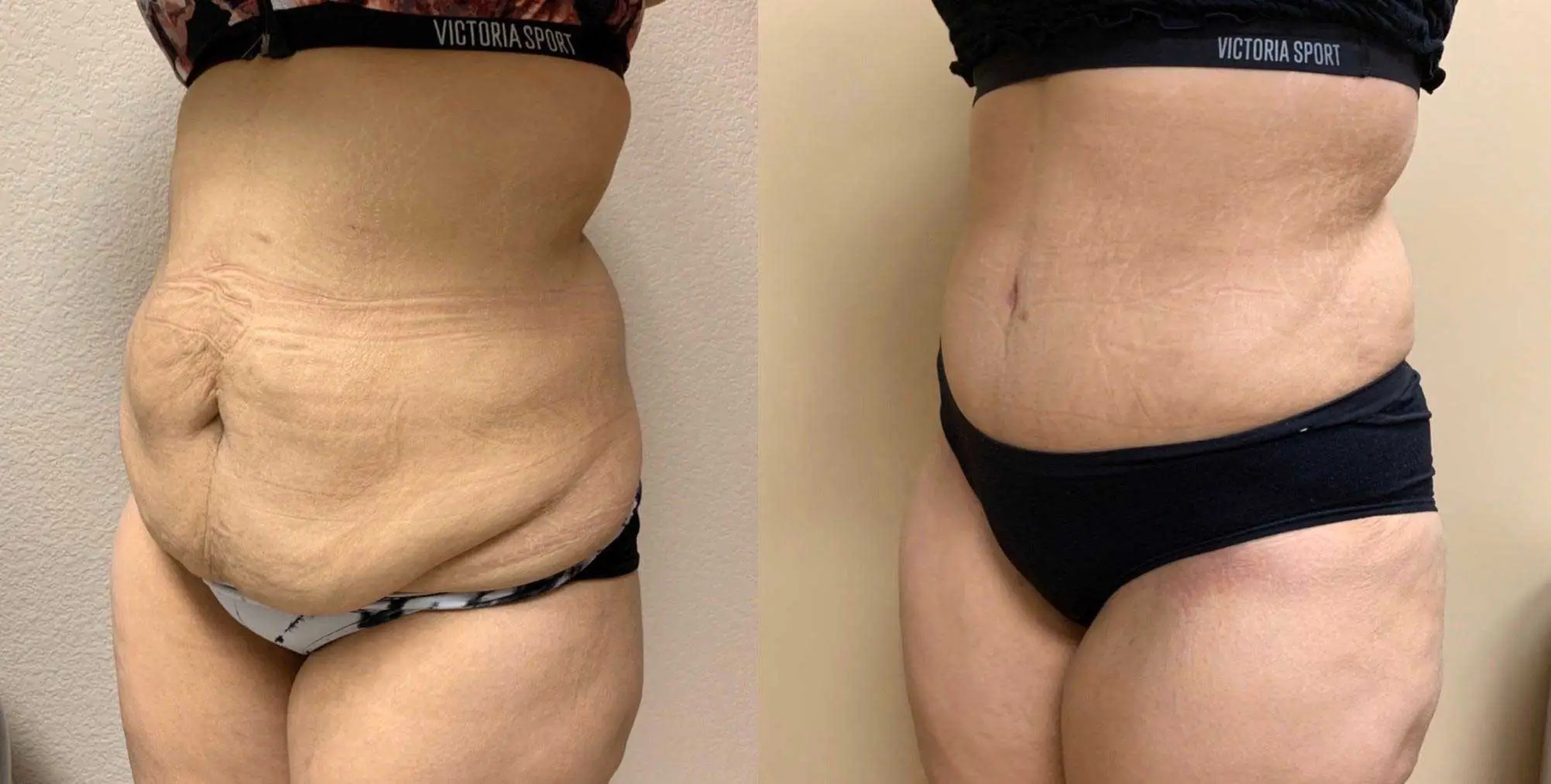 Tummy Tuck Before & After Case Number 00031