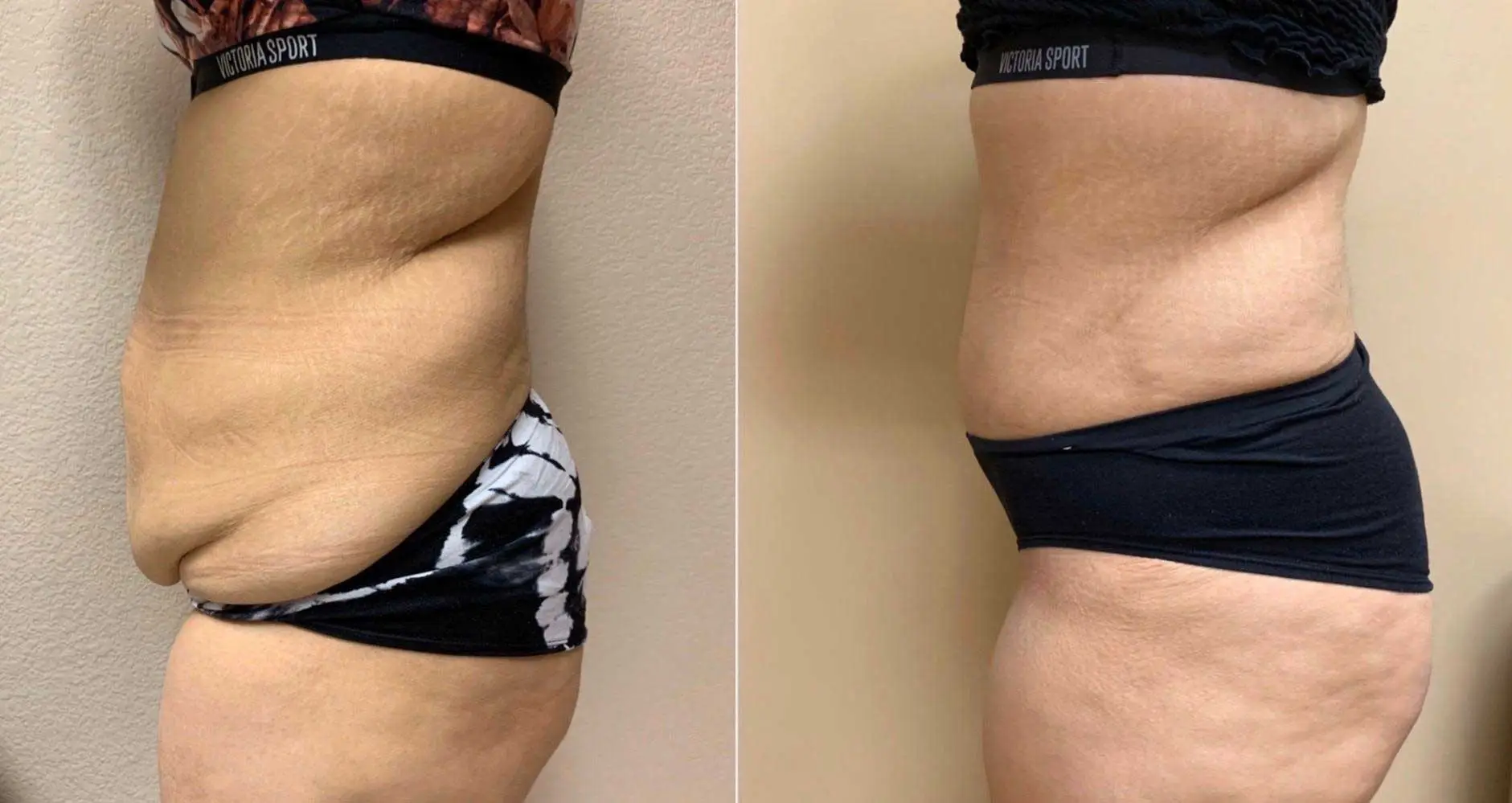 Tummy Tuck Before & After Case Number 00031